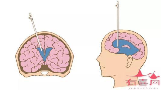什么是小儿脑积水